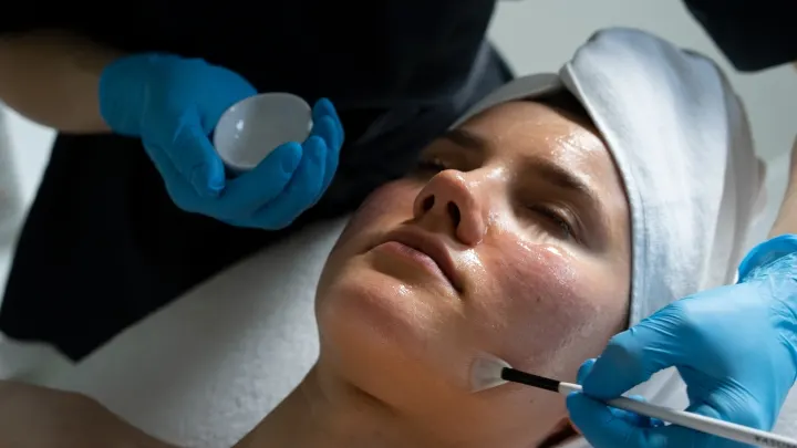 Peeling z kwasem migdałowym w Swarzędzu — terapia wygładzająca